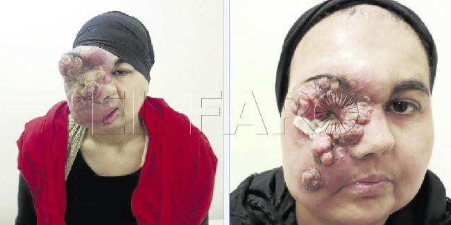Ganar la batalla al sarcoma