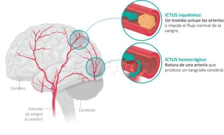 ictus