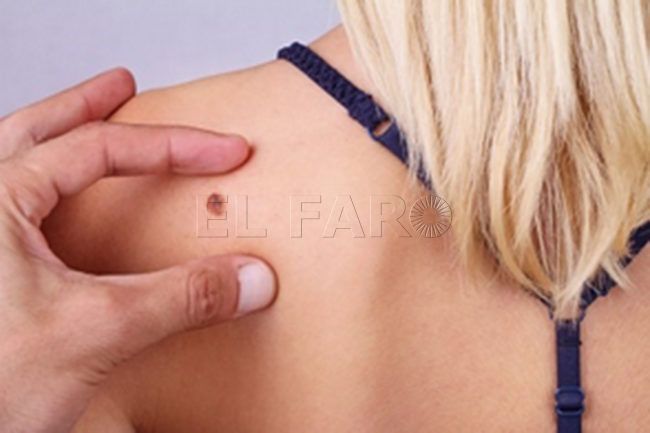 Más de 78.000 personas sufren cáncer de piel al año