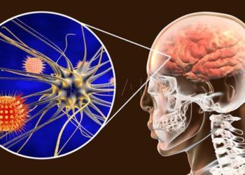 meningitis